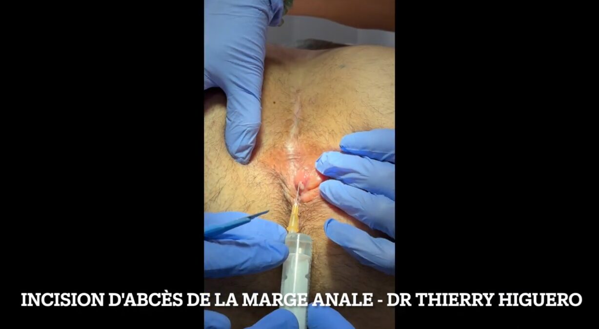 Incision d'un abcès de la marge anale sous anesthésie locale - Dr Higuero